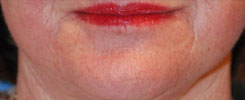 Laser Resurfacing Before & After Photo