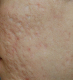 Laser Resurfacing Before & After Photo