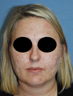 Laser Resurfacing Before & After Photo