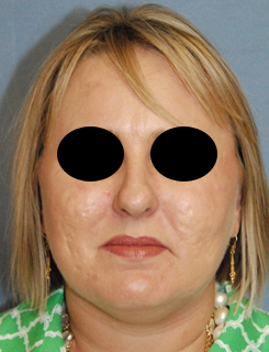 Laser Resurfacing Before & After Photo