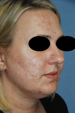 Laser Resurfacing Before & After Photo