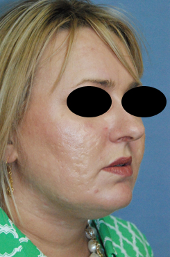 Laser Resurfacing Before & After Photo