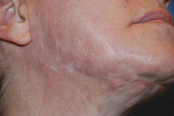 Laser Resurfacing Before & After Photo