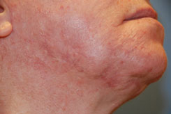 Laser Resurfacing Before & After Photo