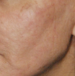 Laser Resurfacing Before & After Photo