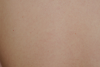 Laser Resurfacing Before & After Photo