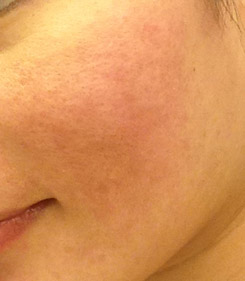 Laser Resurfacing Before & After Photo