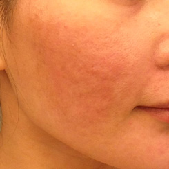 Laser Resurfacing Before & After Photo