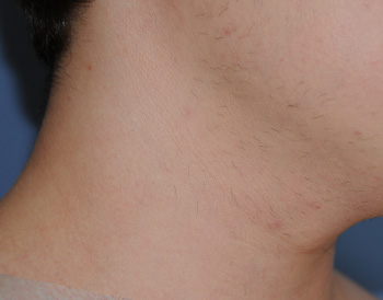 Laser Resurfacing Before & After Photo