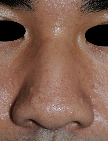 Laser Resurfacing Before & After Photo