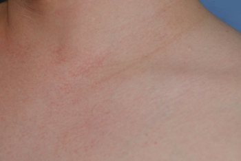 Laser Resurfacing Before & After Photo