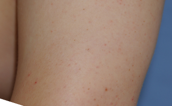 Laser Resurfacing Before & After Photo