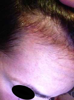 Brow Bone Reduction | Hairline Lowering | Browlift 2 Months After Right Oblique View Brow Bone Reduction | Hairline Lowering | Browlift 2 Months After Right Oblique View
