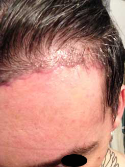 Brow Bone Reduction | Hairline Lowering | Browlift Day 13 After Left Oblique View Brow Bone Reduction | Hairline Lowering | Browlift Day 13 After Left Oblique View