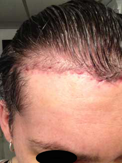 Brow Bone Reduction | Hairline Lowering | Browlift Day 7 After Right Oblique View Brow Bone Reduction | Hairline Lowering | Browlift Day 7 After Right Oblique View