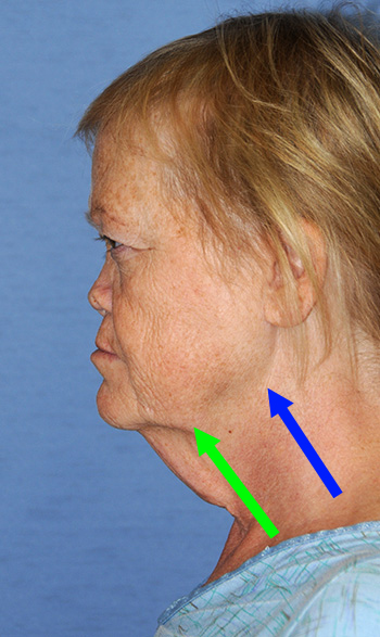 Before and After Neck Lift Showing Volume Loss in the Jawline and showing where the Jowls are