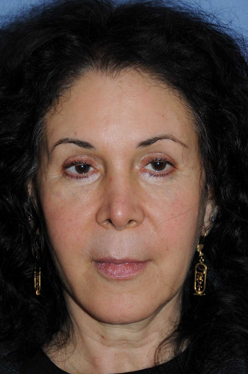 Incision Less Face Eyelift After Image Front View Incision Less Face Lift Eyelift After Image Front View
