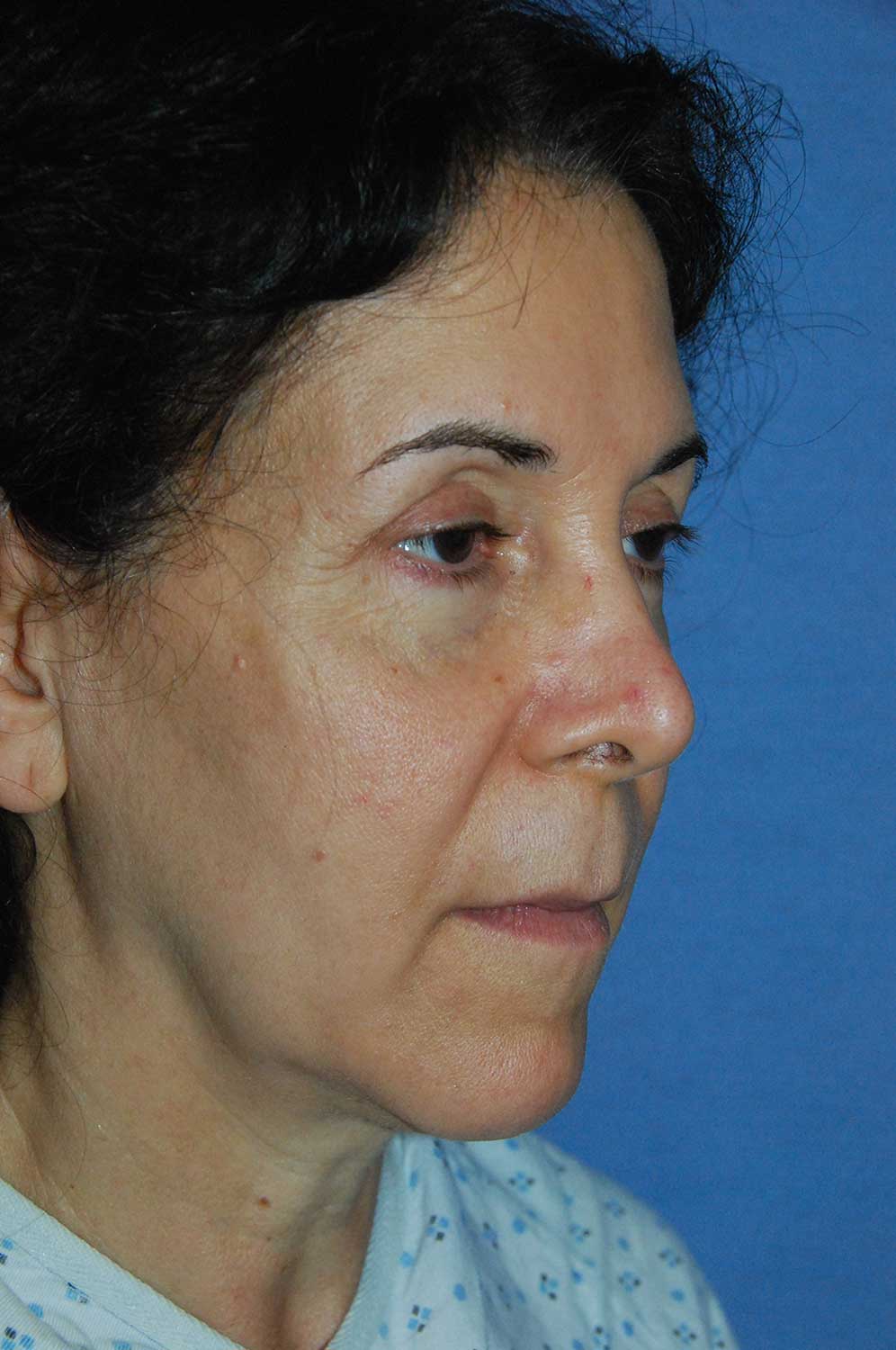 Incision Less Face Eyelift Before Image Oblique View Incision Less Face Lift Eyelift Before Image Oblique View