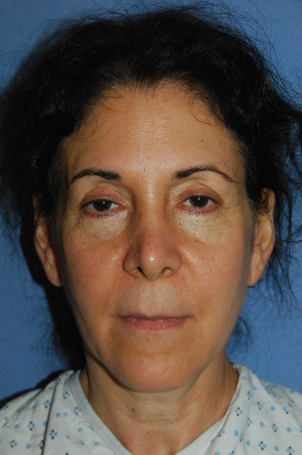 Incision Less Face Eyelift Before Image Front View Incision Less Face Lift Eyelift Before Image Front View