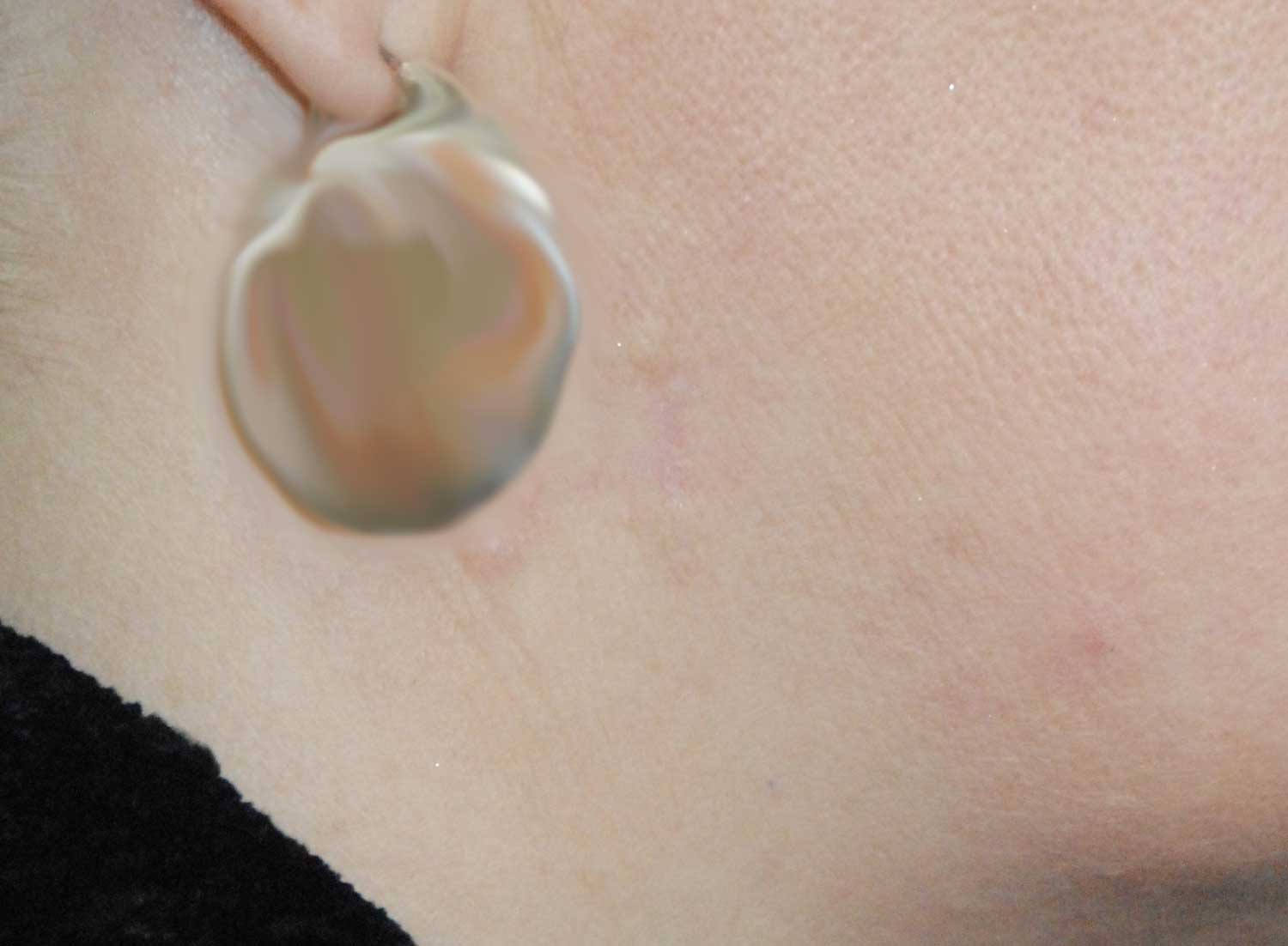 Jawline Mole Skin Lesion After Excisional Removal Jawline Mole Skin Lesion After Excisional Removal