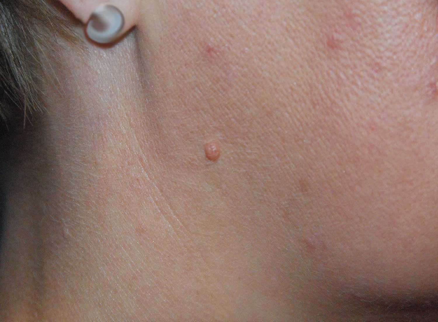 Jawline Mole Skin Lesion Before Excisional Removal Jawline Mole Skin Lesion Before Excisional Removal