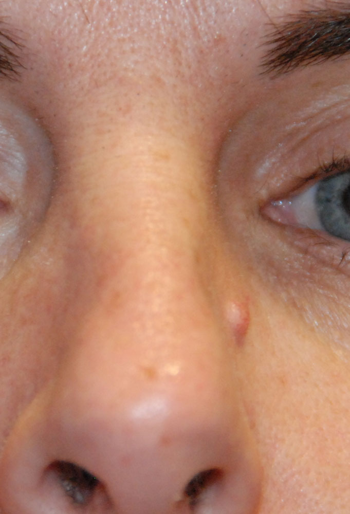 Nose Mole Skin Lesion Before Excisional Removal Nose Mole Skin Lesion Before Excisional Removal
