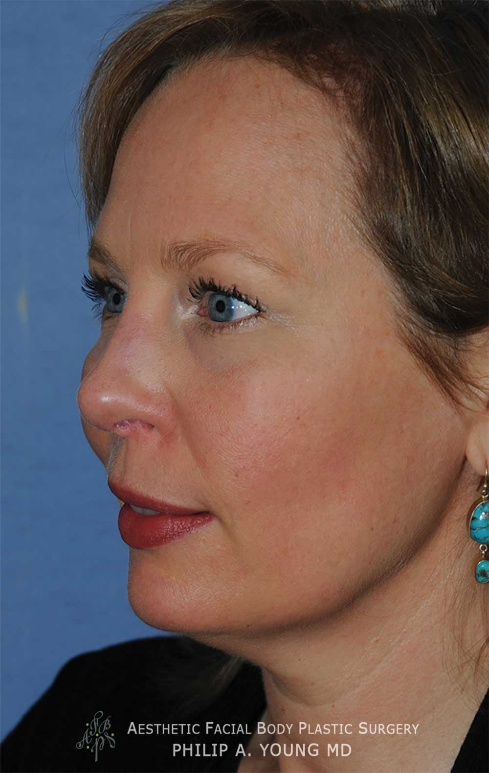 After Revision Rhinoplasty for Crooked Tip, Crooked Nasal Bridge, Nose Bridge Dorsal Irregularities, Hook & Droopy Nasal Tip, Retracted Alae Nostrils Left Oblique View.