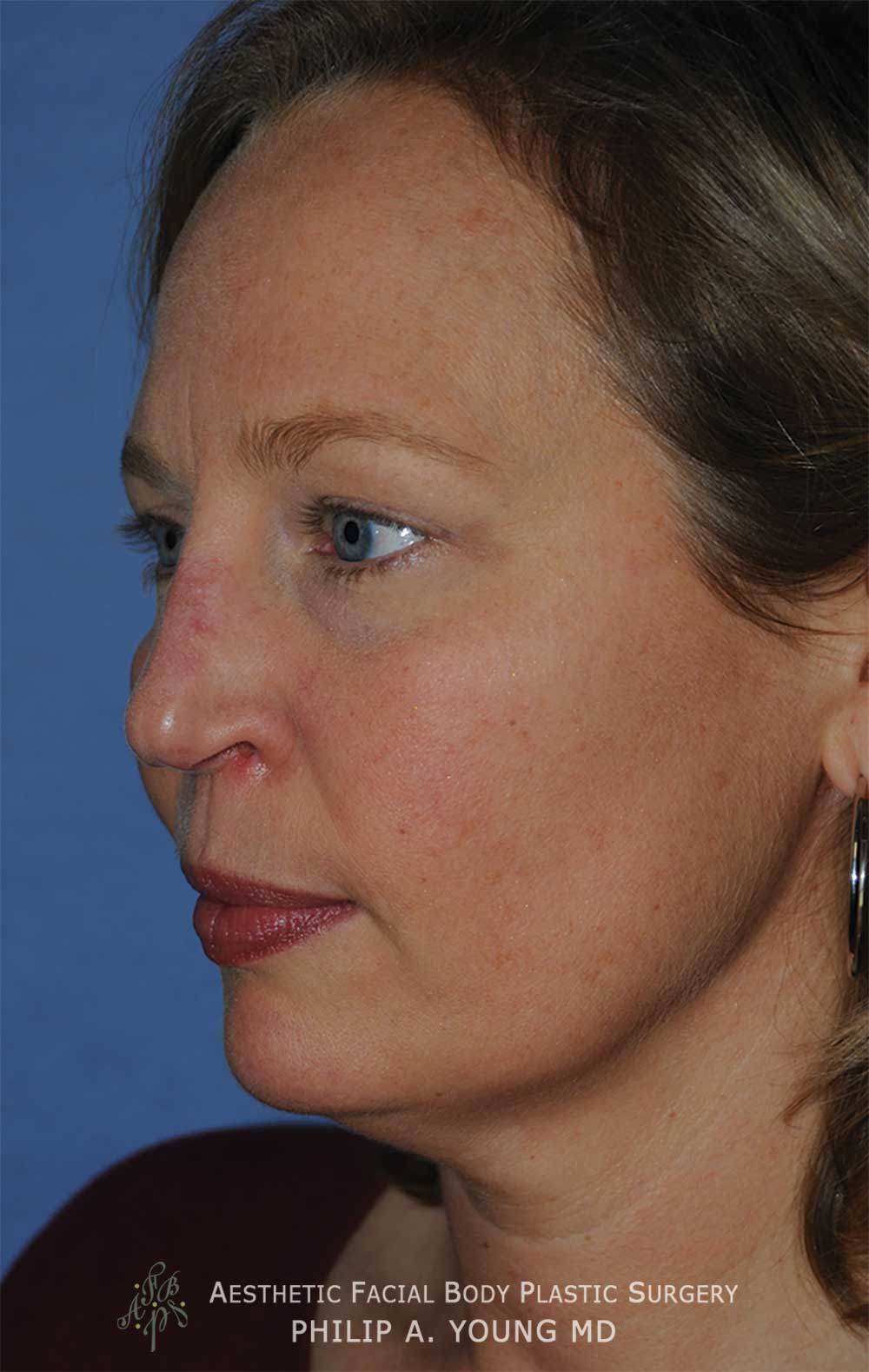 Before Revision Rhinoplasty for Crooked Tip, Crooked Nasal Bridge, Nose Bridge Dorsal Irregularities, Hook & Droopy Nasal Tip, Retracted Alae Nostrils Left Oblique View.