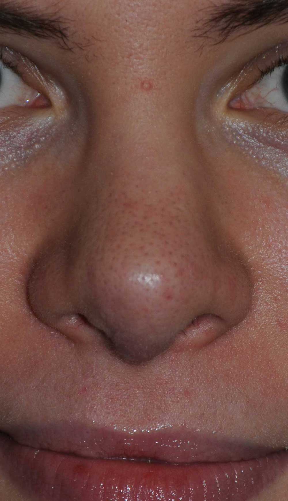 After Revision Rhinoplasty for Droopy Tip, Tip Irregularities, Nasal Bridge Bump, Narrowed Right more than Left Nasal Airway, Collapsing Nostrils, and Crooked Nose.