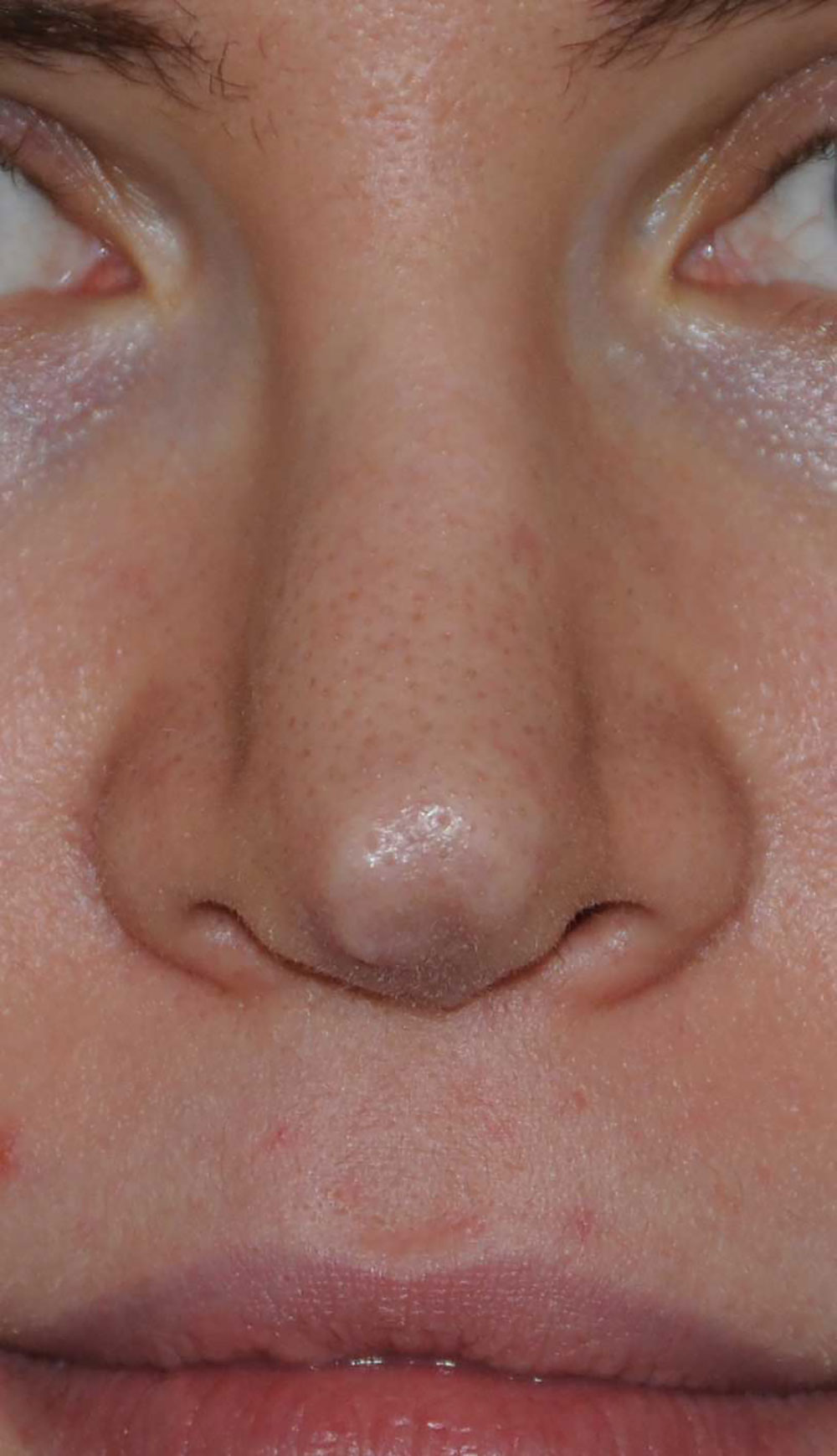 Revision Rhinoplasty for Droopy Tip, Tip Irregularities, Nasal Bridge Bump, Narrowed Right more than Left Nasal Airway, Collapsing Nostrils, and Crooked Nose
