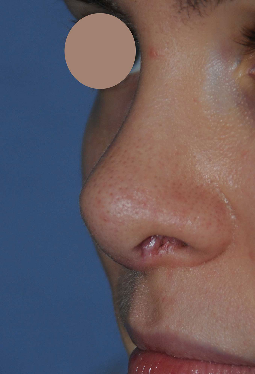 After Revision Rhinoplasty for Droopy Tip, Tip Irregularities, Nasal Bridge Bump, Narrowed Right more than Left Nasal Airway, Collapsing Nostrils, and Crooked Nose Left Oblique View.