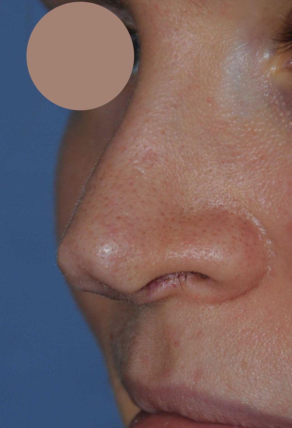 Revision Rhinoplasty for Droopy Tip, Tip Irregularities, Nasal Bridge Bump, Narrowed Right more than Left Nasal Airway, Collapsing Nostrils, and Crooked Nose Left Oblique View