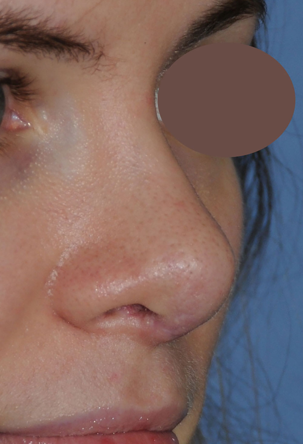 After Revision Rhinoplasty for Droopy Tip, Tip Irregularities, Nasal Bridge Bump, Narrowed Right more than Left Nasal Airway, Collapsing Nostrils, and Crooked Nose Right Oblique View.