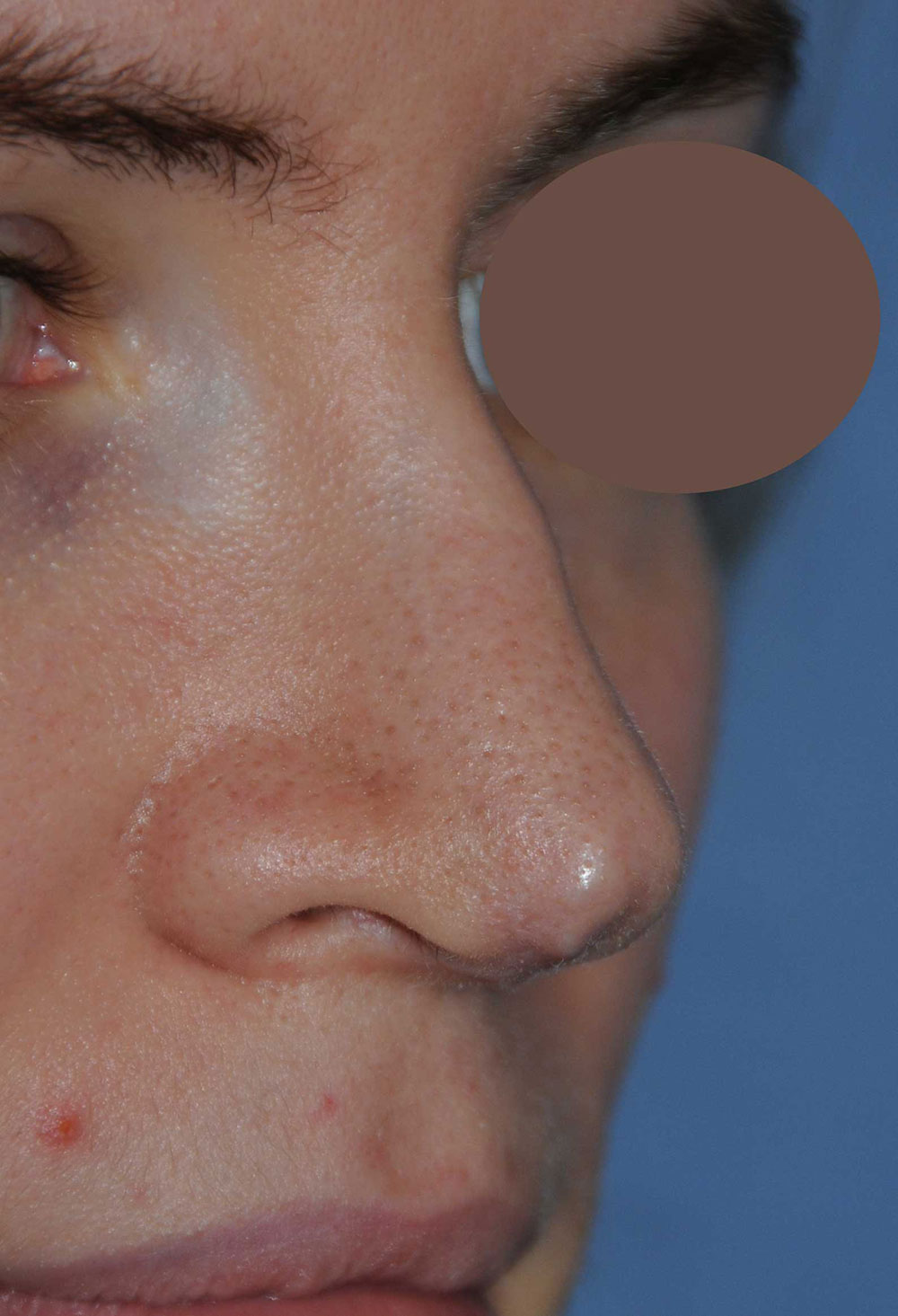 Revision Rhinoplasty for Droopy Tip, Tip Irregularities, Nasal Bridge Bump, Narrowed Right more than Left Nasal Airway, Collapsing Nostrils, and Crooked Nose Right Oblique View