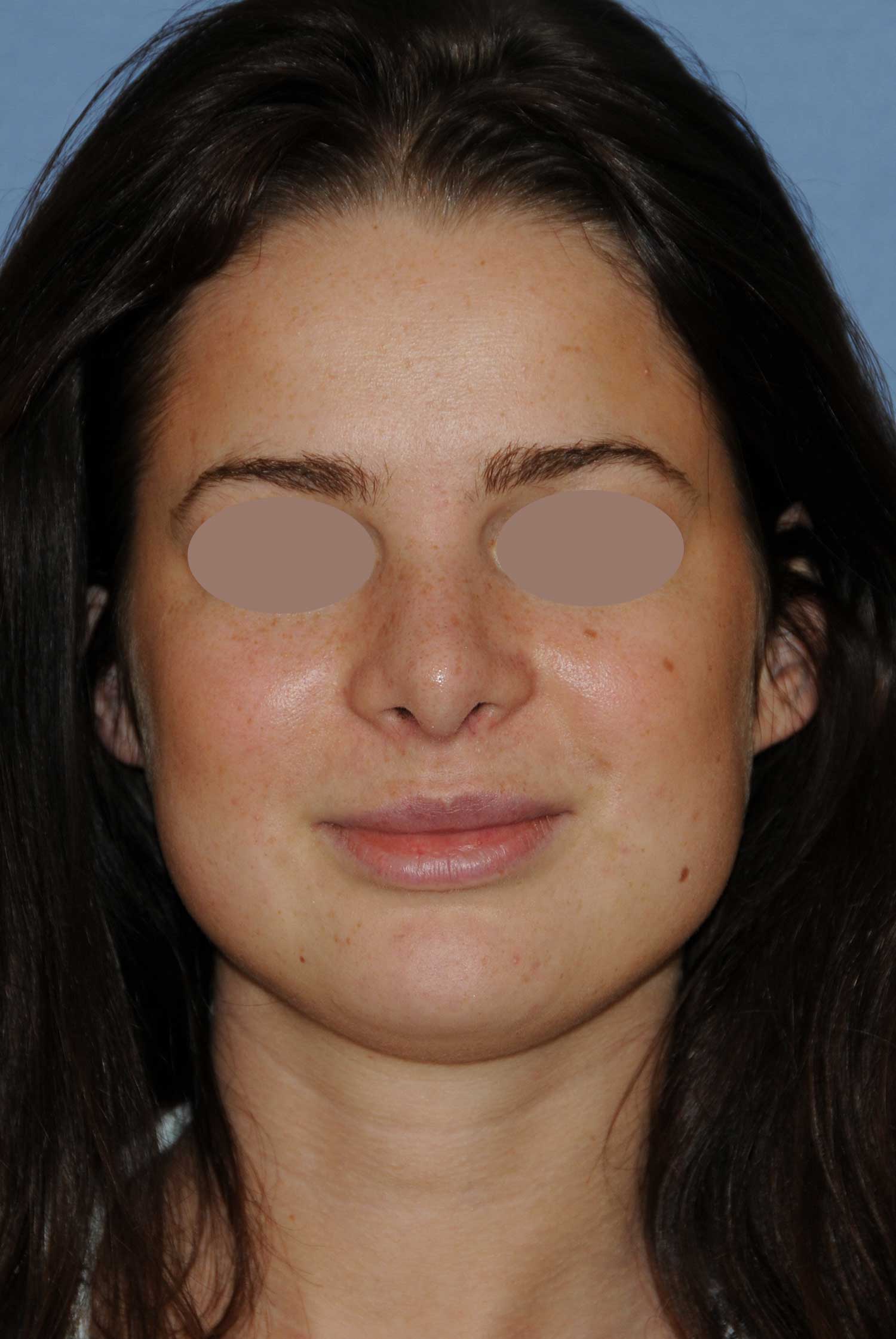 After Rhinoplasty For A Large, Wide Nasal Bridge and Bulbous Nasal Tip After Rhinoplasty For A Large, Wide Nasal Bridge and Bulbous Nasal Tip