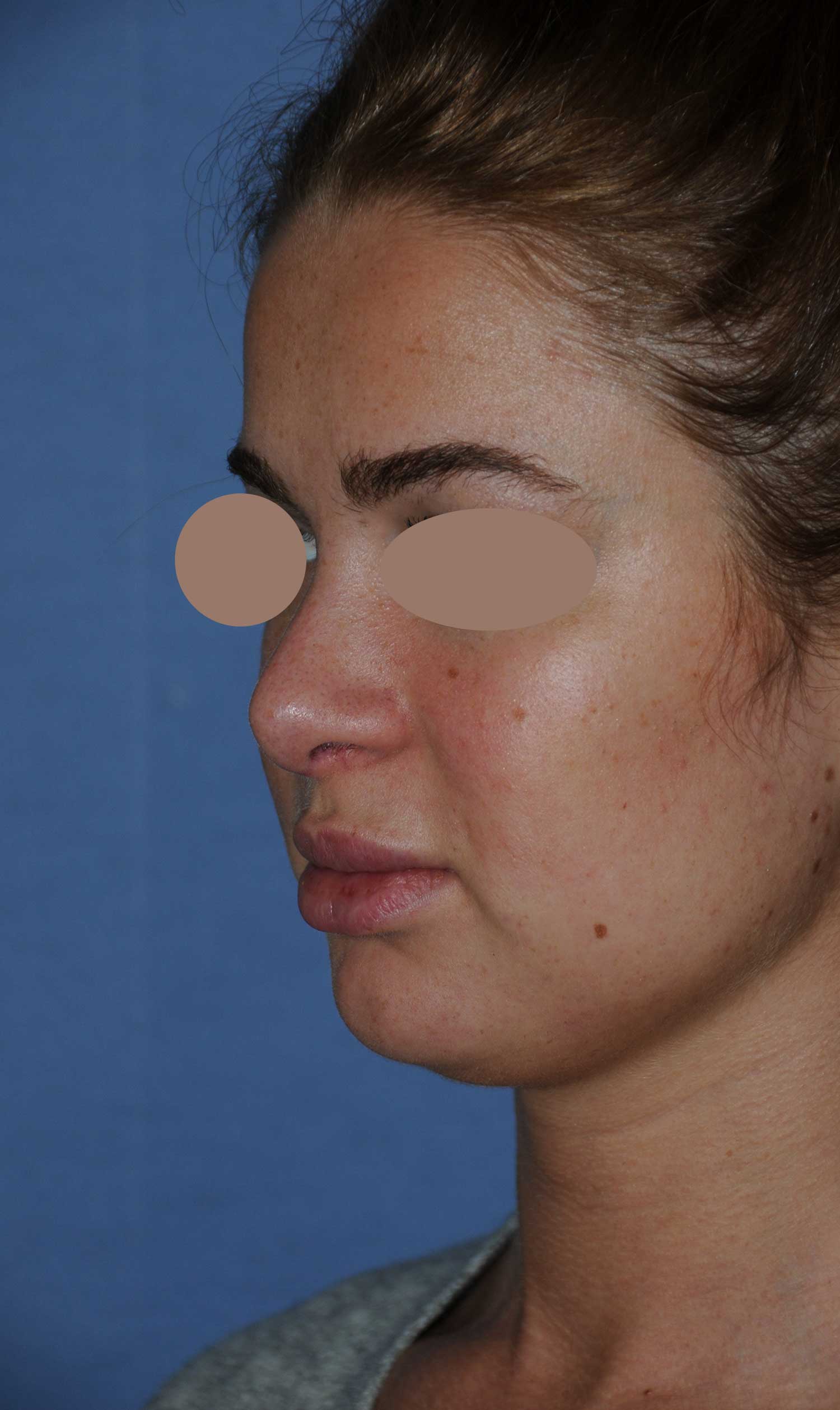 After Rhinoplasty For A Large, Wide Nasal Bridge and Bulbous, Hook, & Hanging Nasal Tip Left Oblique Angled View After Rhinoplasty For A Large, Wide Nasal Bridge and Bulbous, Hook, & Hanging Nasal Tip Left Oblique Angled View