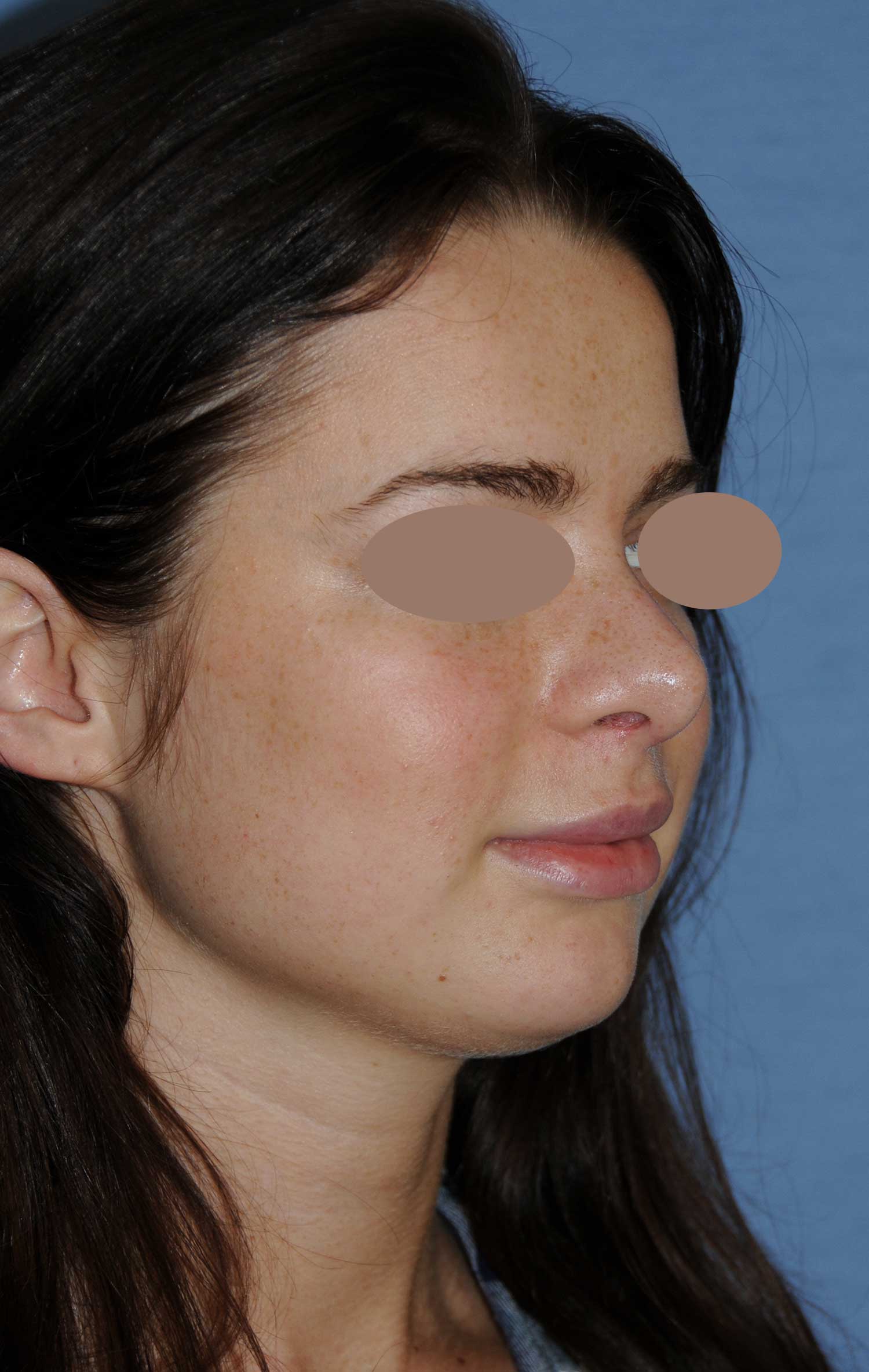 After Rhinoplasty For A Large, Wide Nasal Bridge and Bulbous, Hook, & Hanging Nasal Tip Oblique Angled View After Rhinoplasty For A Large, Wide Nasal Bridge and Bulbous, Hook, & Hanging Nasal Tip Oblique Angled View