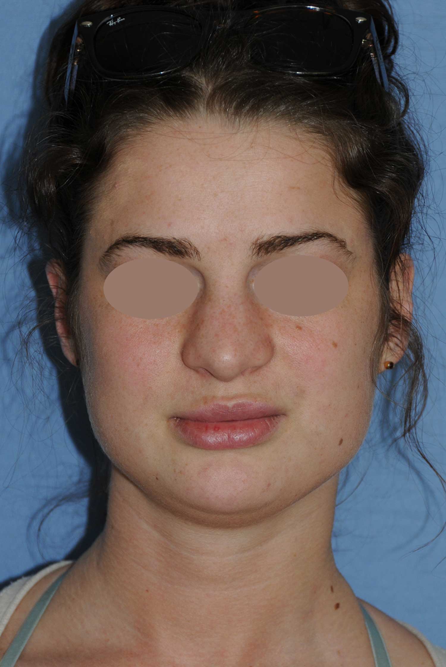 Before Rhinoplasty For A Large, Wide Nasal Bridge and Bulbous Nasal Tip Before Rhinoplasty For A Large, Wide Nasal Bridge and Bulbous Nasal Tip