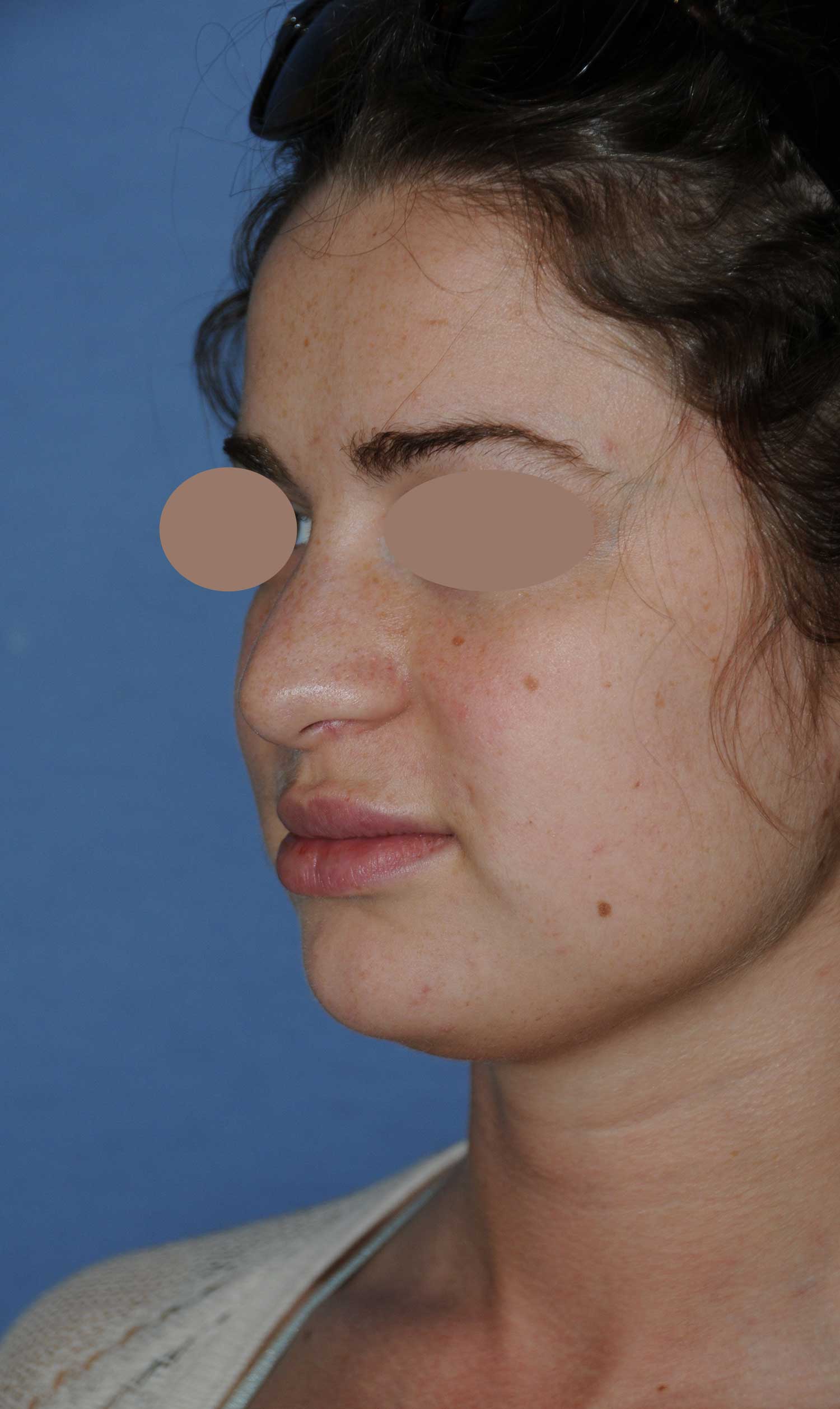 Before Rhinoplasty For A Large, Wide Nasal Bridge and Bulbous, Hook, & Hanging Nasal Tip Left Oblique Angled View Before Rhinoplasty For A Large, Wide Nasal Bridge and Bulbous, Hook, & Hanging Nasal Tip Left Oblique Angled View