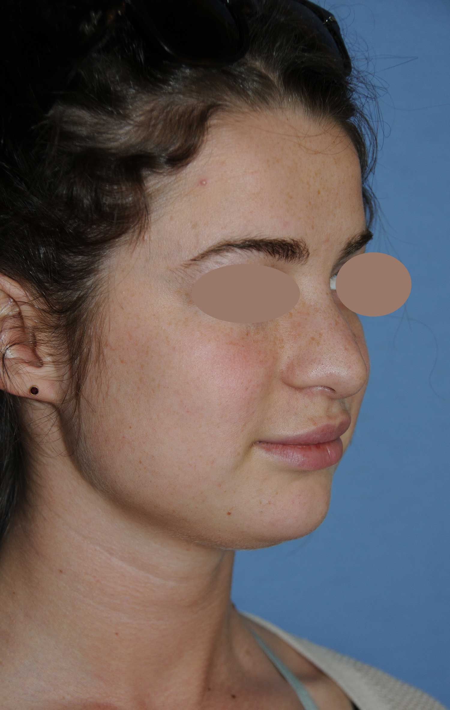 Before Rhinoplasty For A Large, Wide Nasal Bridge and Bulbous, Hook, & Hanging Nasal Tip Oblique Angled View Before Rhinoplasty For A Large, Wide Nasal Bridge and Bulbous, Hook, & Hanging Nasal Tip Oblique Angled View