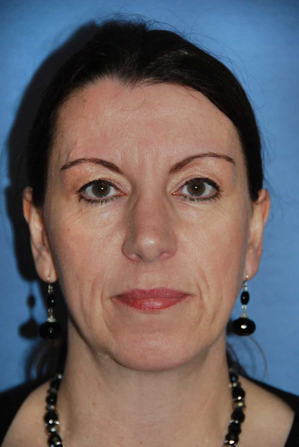 After Rhinoplasty for Hook Nose, Dorsal Hump, and Chin Implant for a weak and retruded chin front view