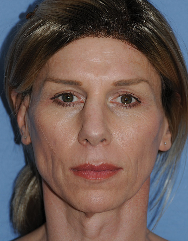 Before Transgender Feminization Rhinoplasty Procedure Front View Before Transgender Feminization Rhinoplasty Procedure Front View
