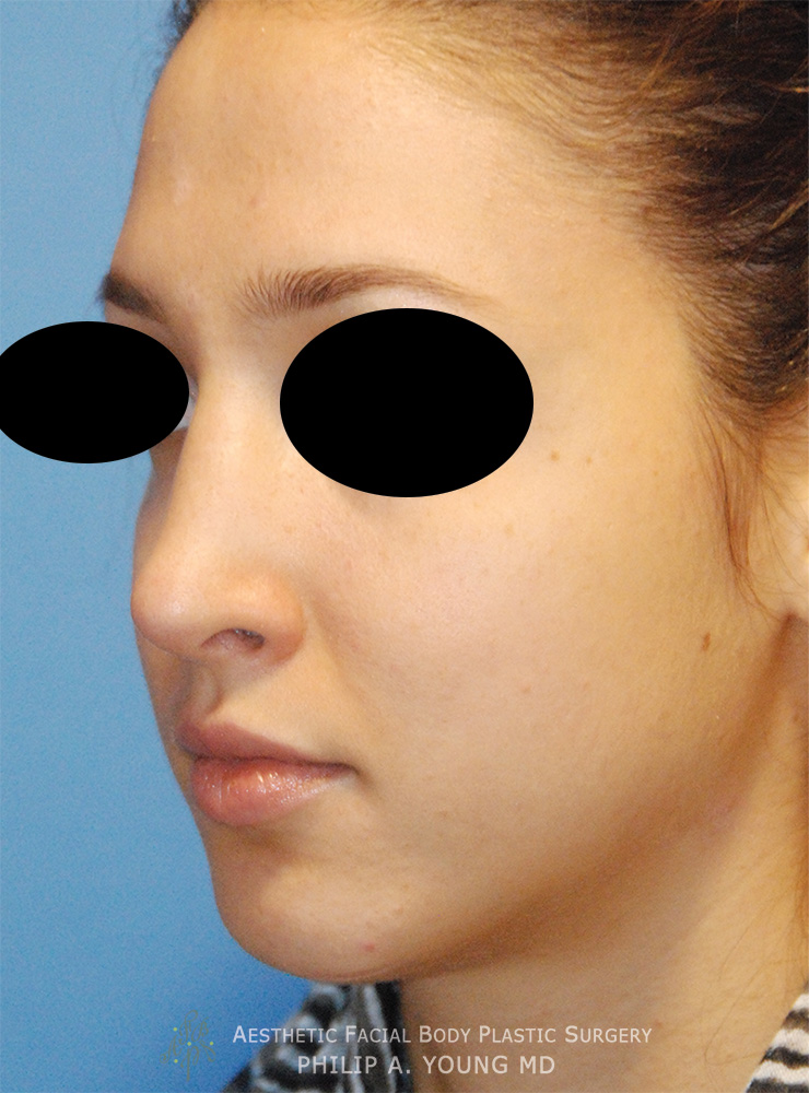 After Rhinoplasty For Nasal Hump Bump Reduction Left Oblique View