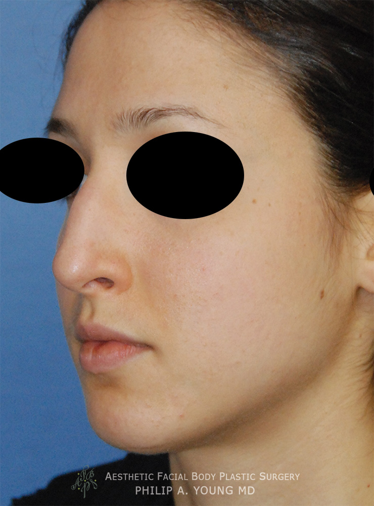 Before Rhinoplasty For Nasal Hump Bump Reduction Left Oblique View