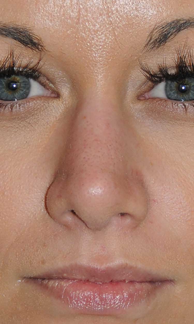 Rhinoplasty for a Bulbous / Plunging / Hook / Hanging Nasal Tip, Wide Middle Third, and Relatively Prominent Nasal Bridge After Close Up Front View Rhinoplasty for a Bulbous / Plunging / Hook / Hanging Nasal Tip, Wide Middle Third, and Relatively Prominent Nasal Bridge After Close Up Front View