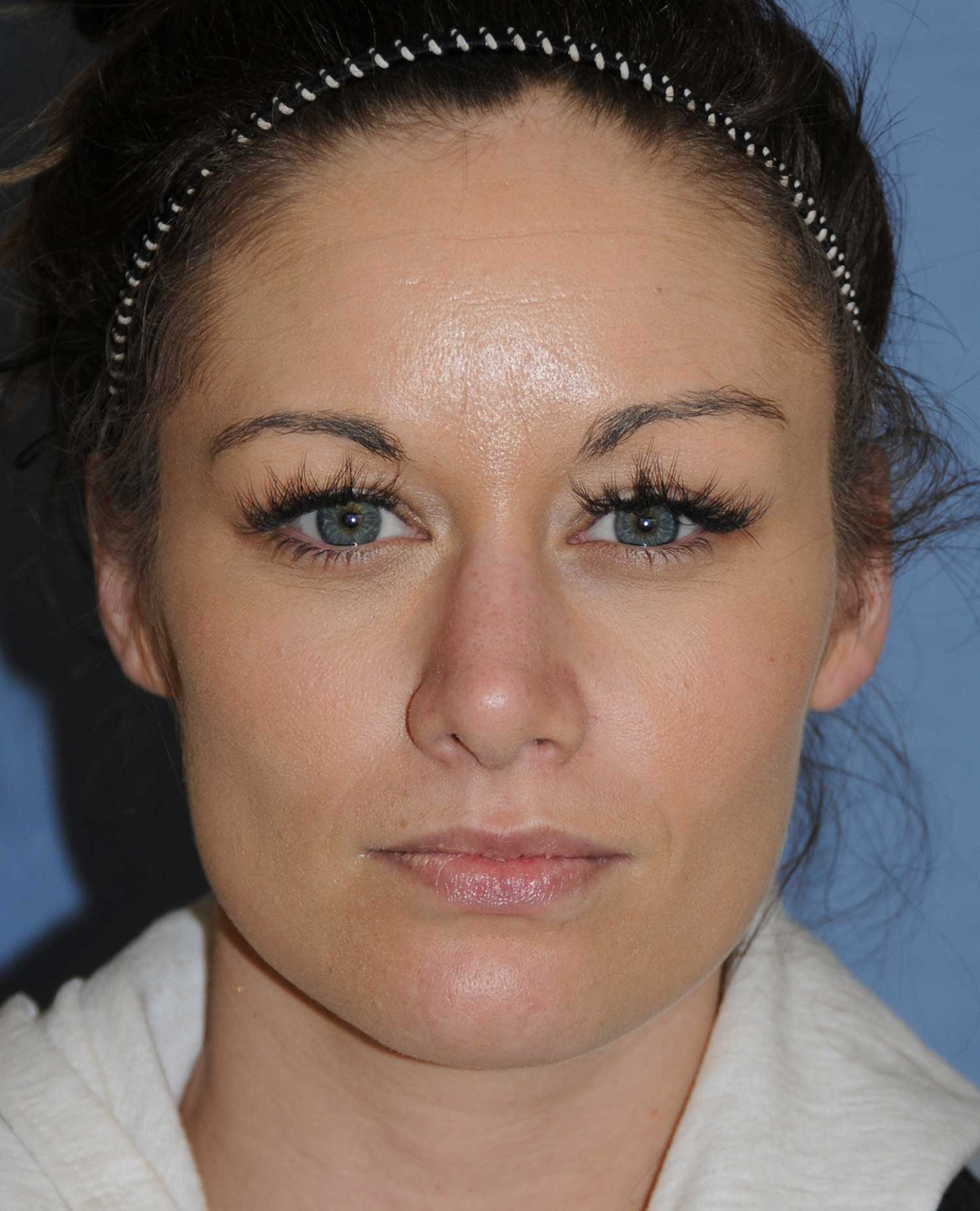 Rhinoplasty for a Bulbous / Plunging / Hook / Hanging Nasal Tip, Wide Middle Third, and Relatively Prominent Nasal Bridge After Front View Rhinoplasty for a Bulbous / Plunging / Hook / Hanging Nasal Tip, Wide Middle Third, and Relatively Prominent Nasal Bridge After Front View