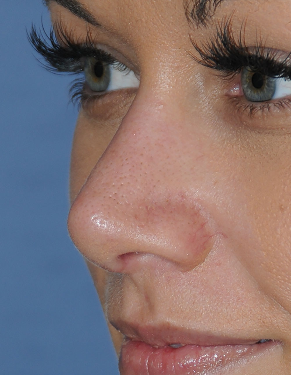 Rhinoplasty for a Bulbous / Plunging / Hook / Hanging Nasal Tip, Wide Middle Third, and Relatively Prominent Nasal Bridge After Left Oblique Close Up View Rhinoplasty for a Bulbous / Plunging / Hook / Hanging Nasal Tip, Wide Middle Third, and Relatively Prominent Nasal Bridge After Left Oblique Close Up View