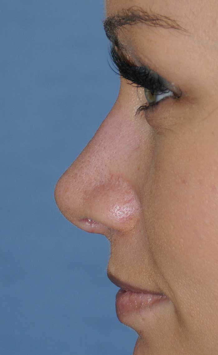 Rhinoplasty for a Bulbous / Plunging / Hook / Hanging Nasal Tip, Wide Middle Third, and Relatively Prominent Nasal Bridge After Left Profile Close Up View Rhinoplasty for a Bulbous / Plunging / Hook / Hanging Nasal Tip, Wide Middle Third, and Relatively Prominent Nasal Bridge After Left Profile Close Up View