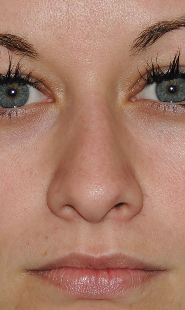 Rhinoplasty for a Bulbous / Plunging / Hook / Hanging Nasal Tip, Wide Middle Third, and Relatively Prominent Nasal Bridge Before Close Up Front View Rhinoplasty for a Bulbous / Plunging / Hook / Hanging Nasal Tip, Wide Middle Third, and Relatively Prominent Nasal Bridge Before Close Up Front View