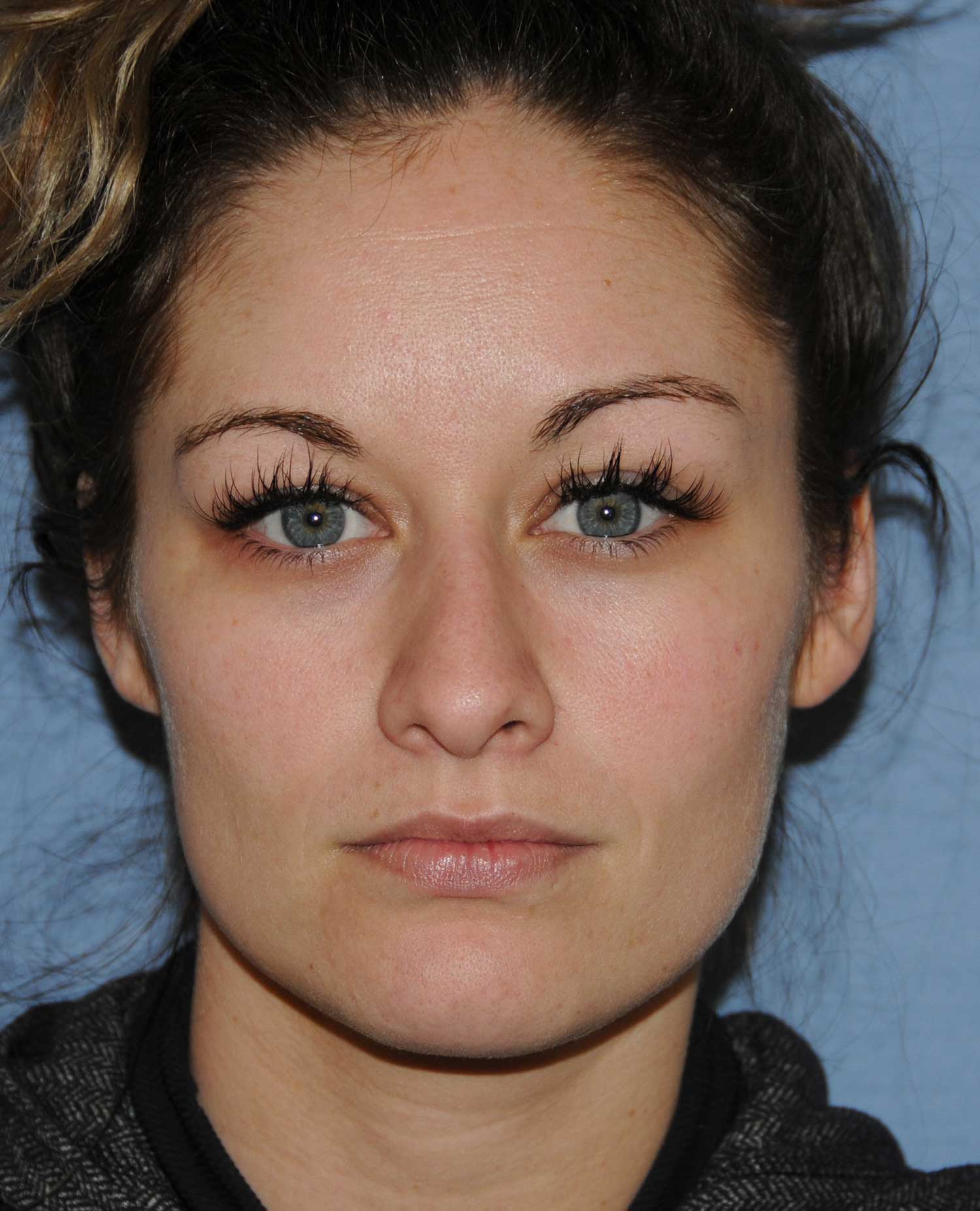 Rhinoplasty for a Bulbous / Plunging / Hook / Hanging Nasal Tip, Wide Middle Third, and Relatively Prominent Nasal Bridge Before Front View Rhinoplasty for a Bulbous / Plunging / Hook / Hanging Nasal Tip, Wide Middle Third, and Relatively Prominent Nasal Bridge Before Front View